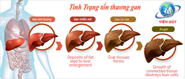Tình trạng tổn thương Gan Tình trạng tổn thương Gan