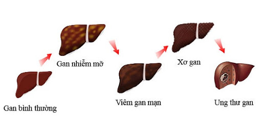tổng quan ung thư gan tổng quan ung thư gan
